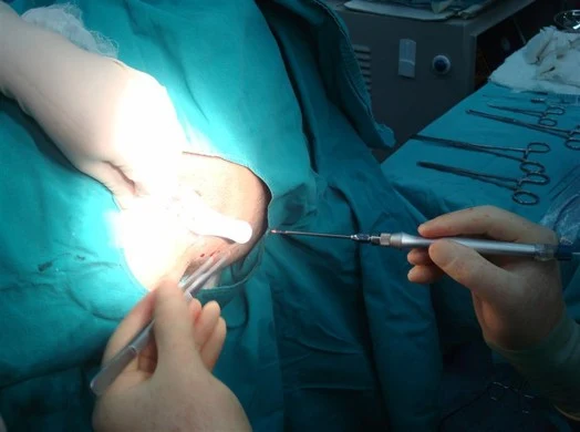 Anorectal Surgery (Laser)