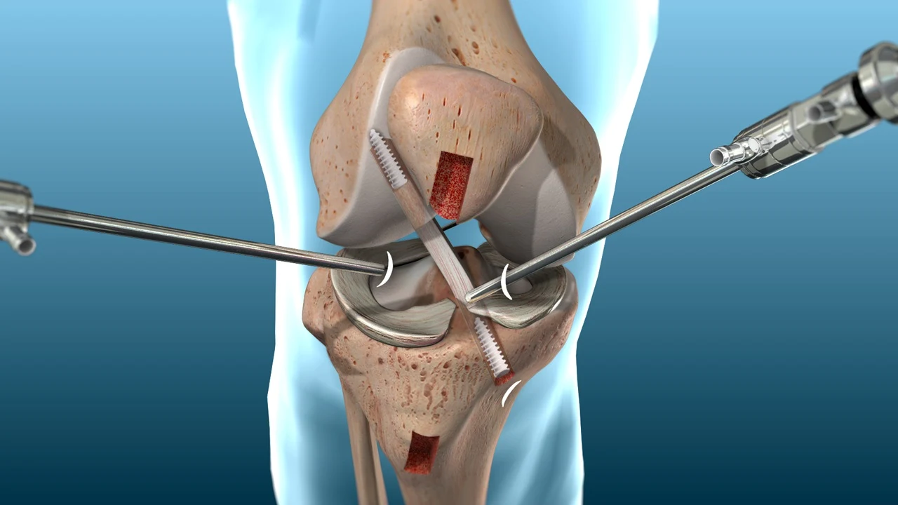 Orthopedic Ligament Reconstruction